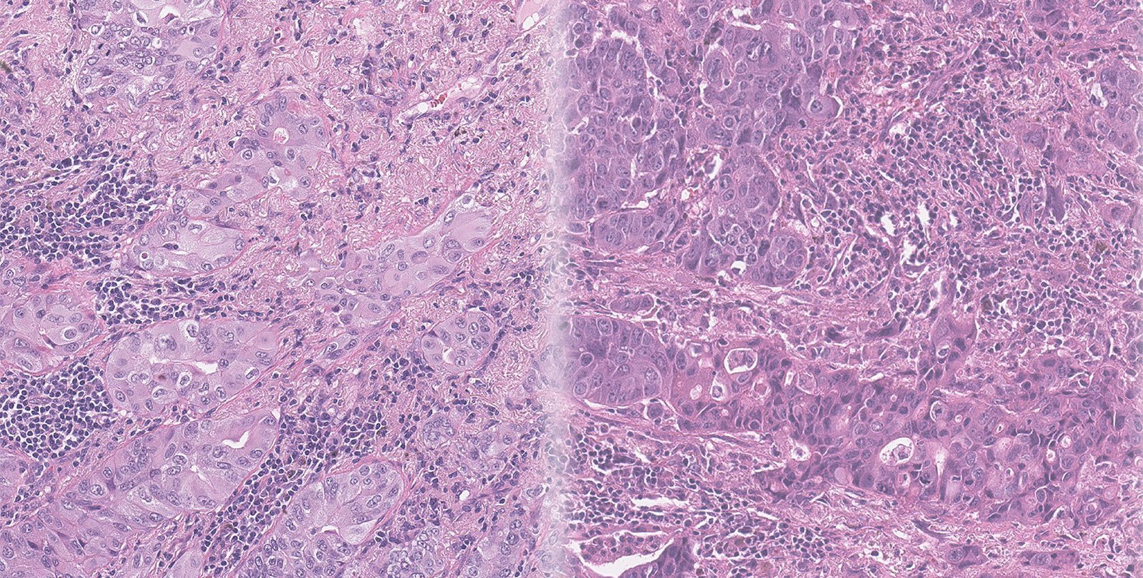 an image displaying purple-stained tissue samples from two different lung cancer patients