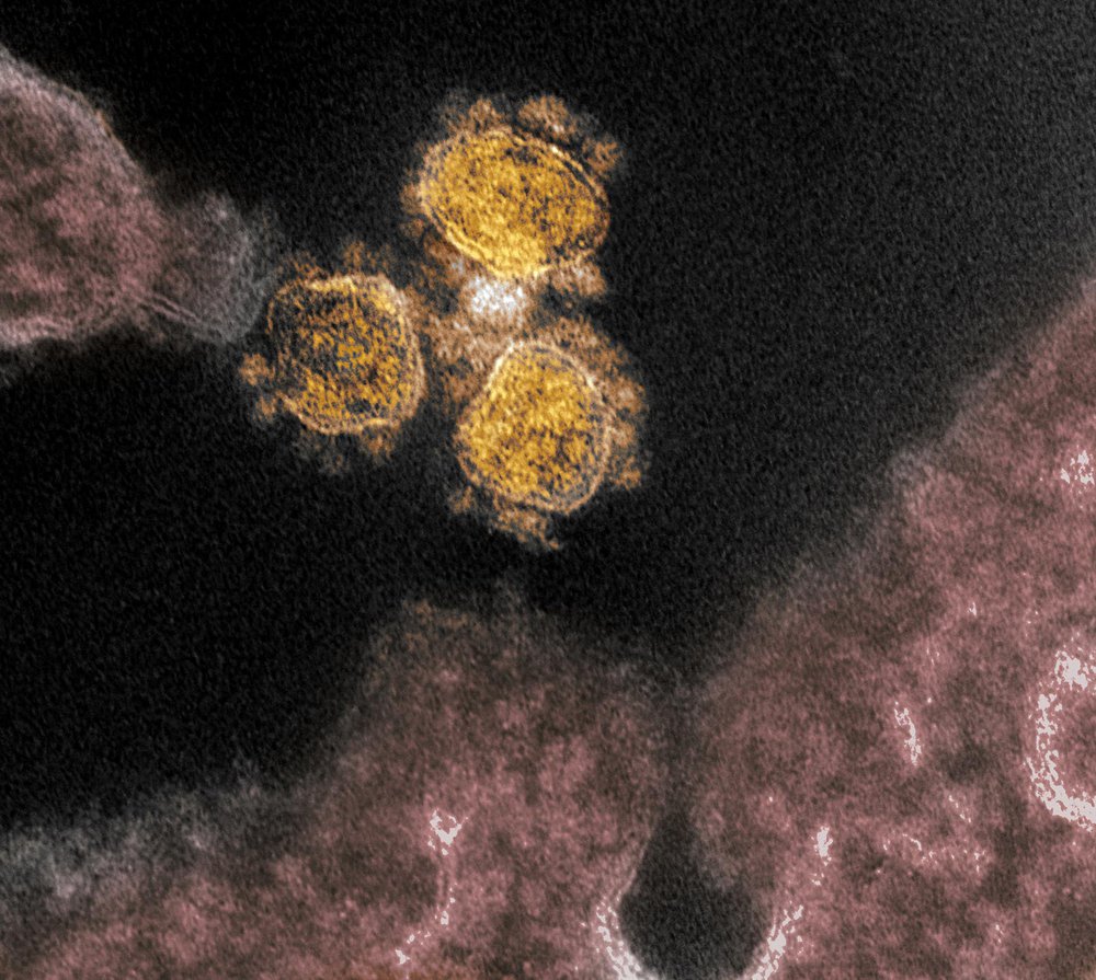 This transmission electron microscope image shows SARS-CoV-2, the virus that causes COVID-19, isolated from a patient in the U.S. Virus particles (round gold objects) are shown emerging from the surface of cells cultured in the lab. The spikes on the outer edge of the virus particles give coronaviruses their name, crown-like.